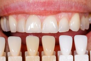 несъемные зубные протезы