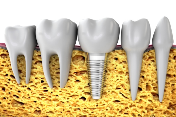 виды зубных имплантатов