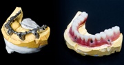 какие бывают покрывные зубные протезы - виды