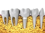 сколько стоит имплантат зуба