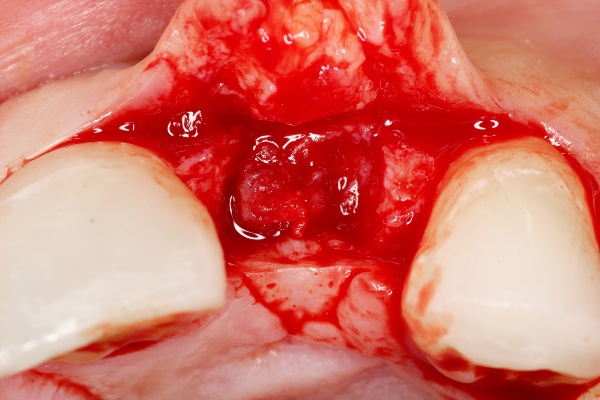 по какой причине может идти кровь после удаления зуба