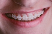 сколько стоят прозрачные брекеты на зубы