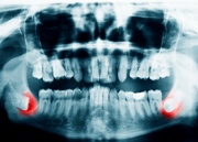 зуб мудрости симптомы температура