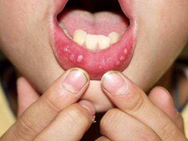 как выглядит Стоматит на губе у ребенка
