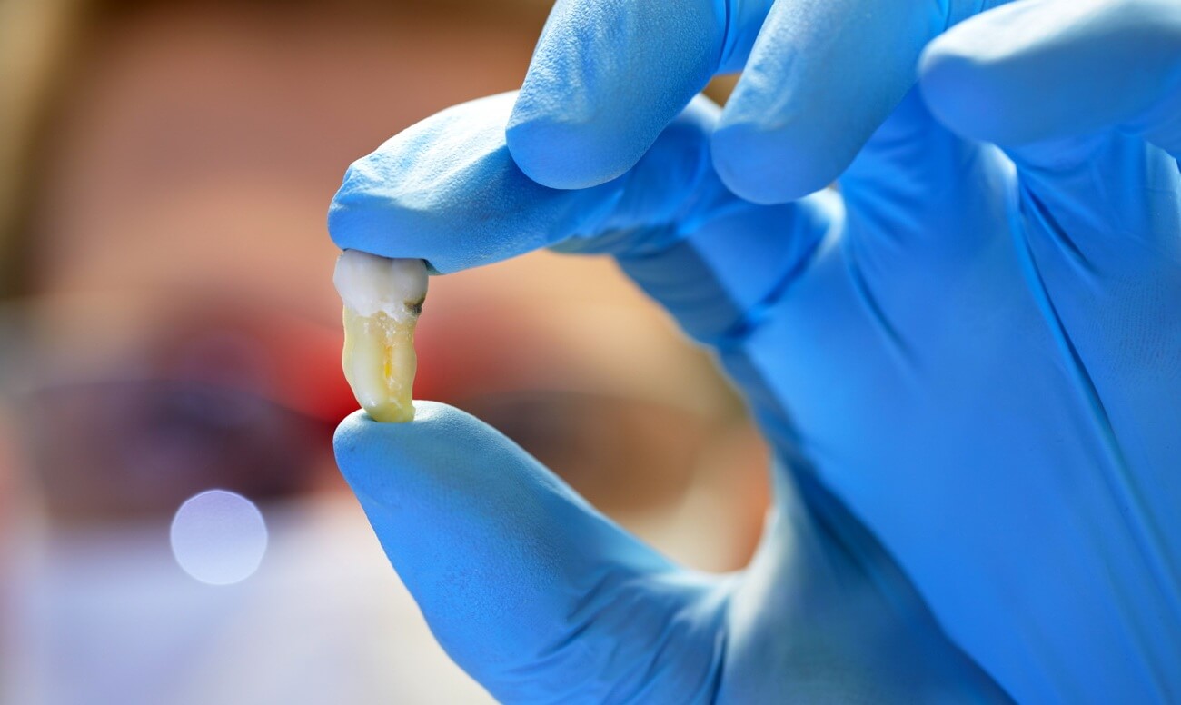 альвеолит способен появиться после удаления зуба