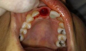нюансы альвеолита при удалении зуба мудрости