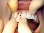 сколько стоит вставить передний зуб