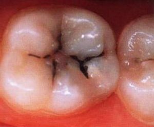 зубы могут болеть из-за кариеса