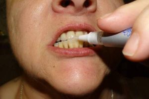показания к применению карандаша для отбеливания зубов