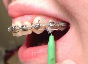 обоснование необходимости использования ершиков для зубов