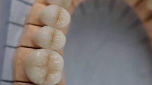 зубные коронки на моляры