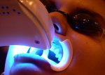 лазерное отбеливание зубов отзывы цена