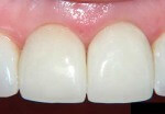 зубы протезирование металлокерамика цены