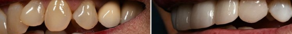 фото до и после исправления кривого зуба