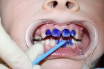 серебрение молочного зуба