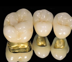 коронки на зубы из драгметаллов