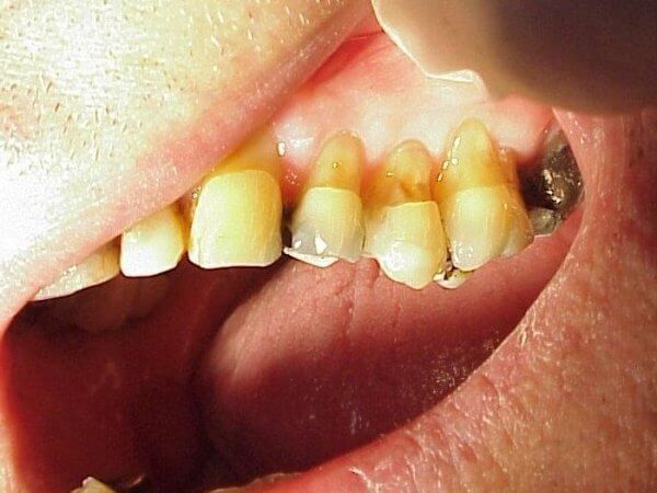что такое клиновидный дефект зуба