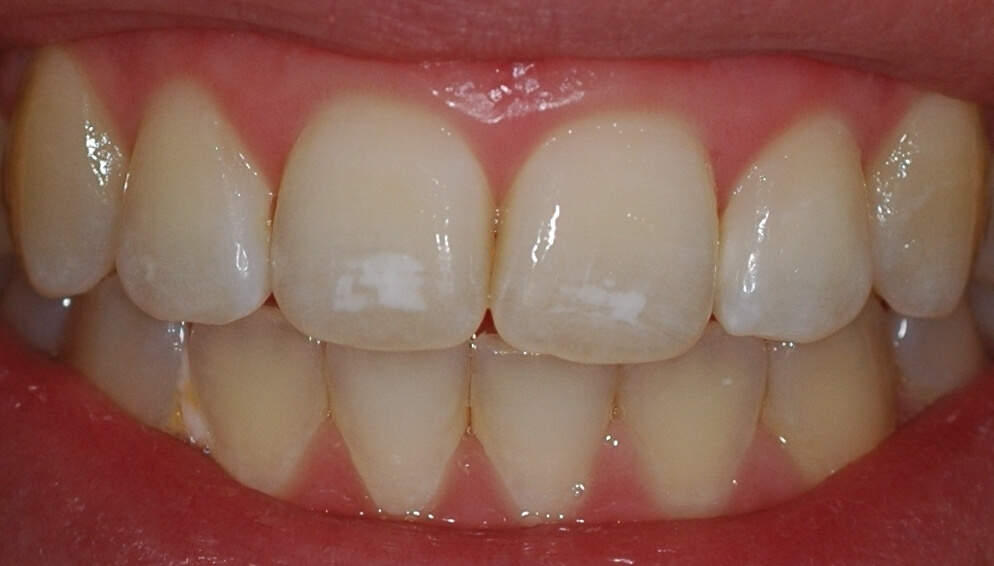 возникновение на зубах белых пятен