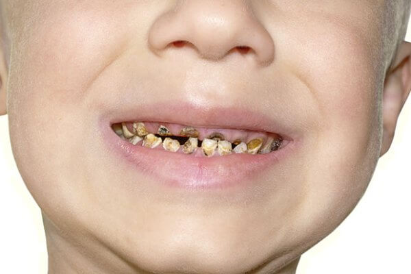 гниющие зубы у детей