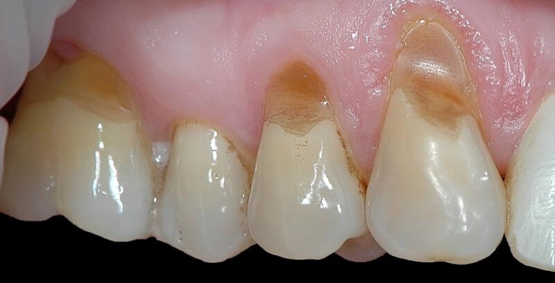 заболевание под названием клиновидный дефект зубов