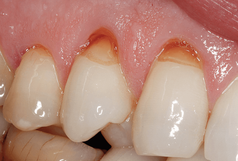 клиновидный дефект зубов у человека и его лечение