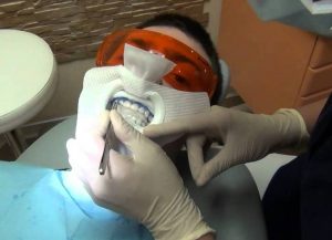 установке тонких пластинок на зубы в стоматологии