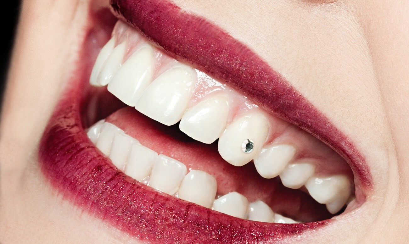 стразы на зубах у людей