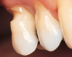 чем может помочь врач ортодонт при клиновидном дефекте зубов