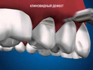 три теории возникновения пришеечного эффекта некариозного характера