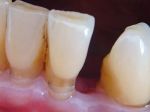 клиновидный дефект зубов лечение народными средствами