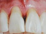 клиновидный дефект зубов причины