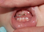 у ребенка крошатся молочные зубы