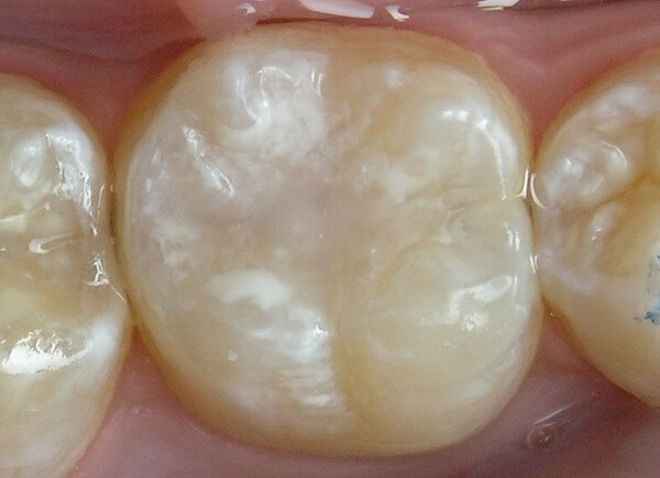 запрет на проведение герметизации фиссур зубов у детей