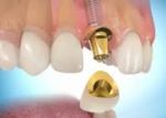 сколько стоит установка имплантанта зуба
