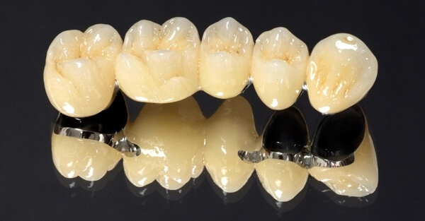 зубной мост из металлокерамики