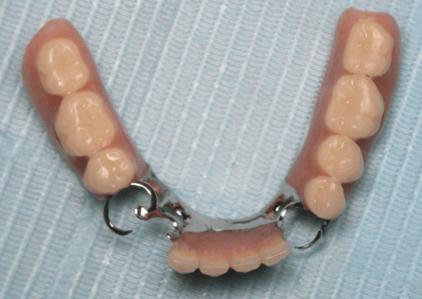 минусы зубных бюгельных протезов на нижнюю челюсть