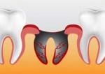 альвеолит после удаления зуба симптомы