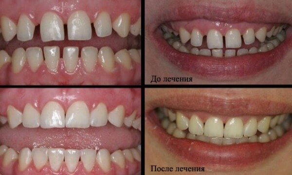 как избавиться от щели между зубами