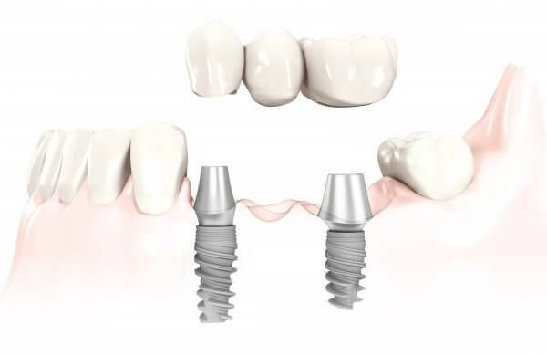 зубной мост с опорой на имплантаты