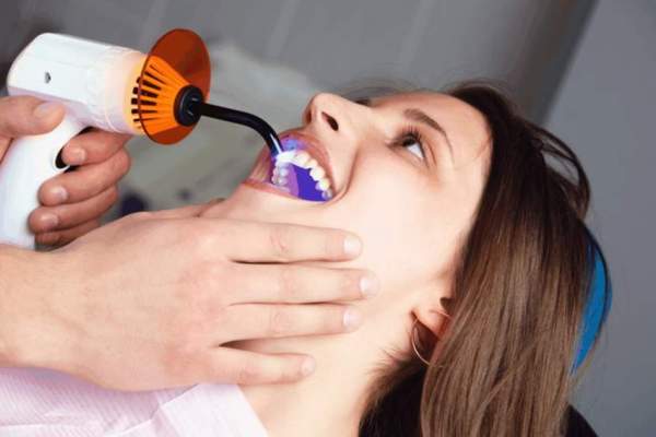 пломбирование зубов световыми пломбами