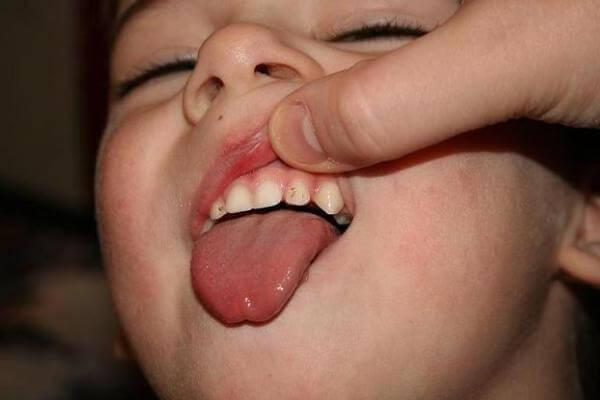 опасность появления черного налета на зубах у ребенка