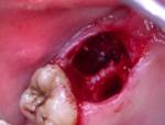 альвеолит после удаления зуба