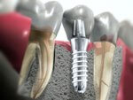 сколько стоит имплантат зуба