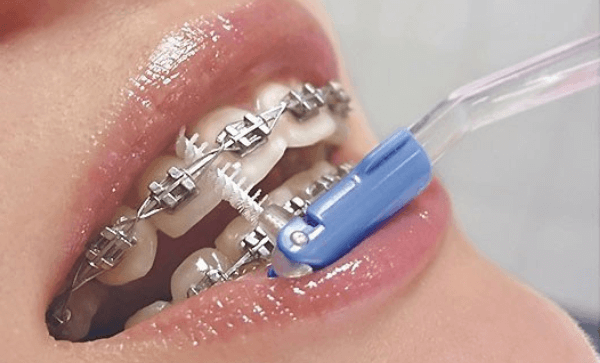чистка зубов для людей с брекетами