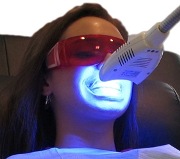 отзывы лазерное отбеливание зубов
