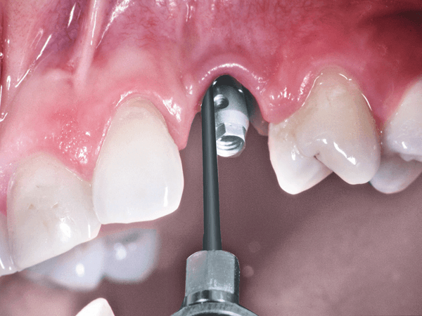 терапия периимплантита в стоматологии