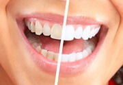 отбеливание зубов содой и перекисью водорода отзывы