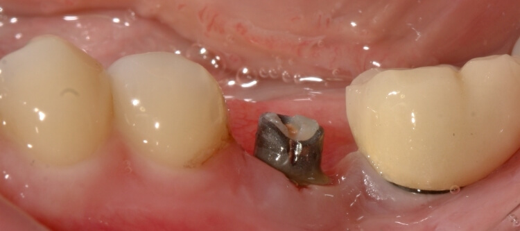 стоматологическое заболевание периимплантит
