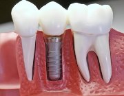 сколько стоит поставить имплантант зуба