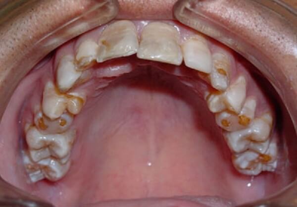гипоплазия зубок у ребенка
